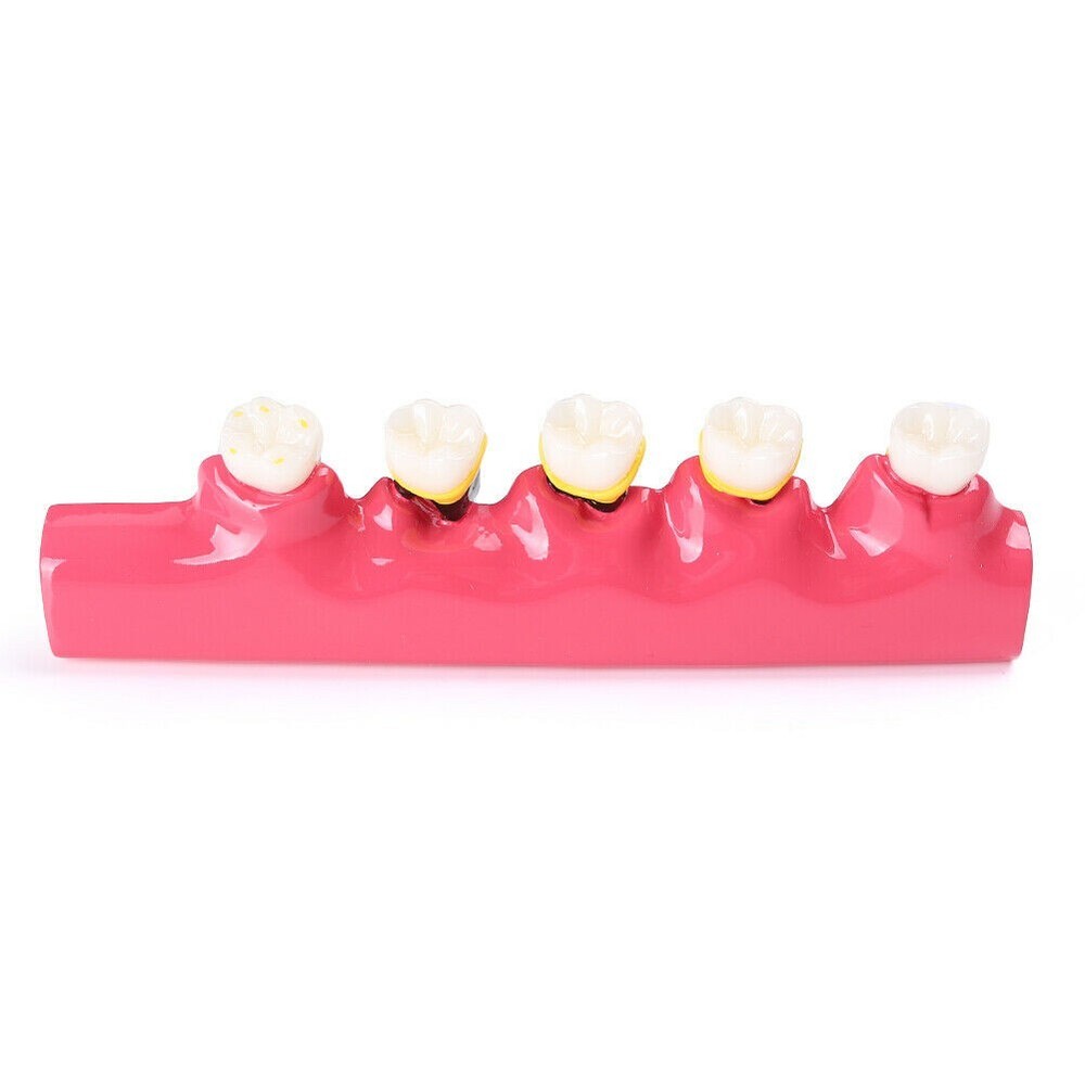 Dental Periodontal Disease Assort Dentoform Pathological Study Teaching Model