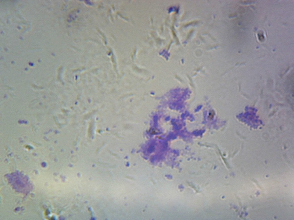 Streptococcus Pneumoniae (Diplococcus); Smear; Gram-Positive
