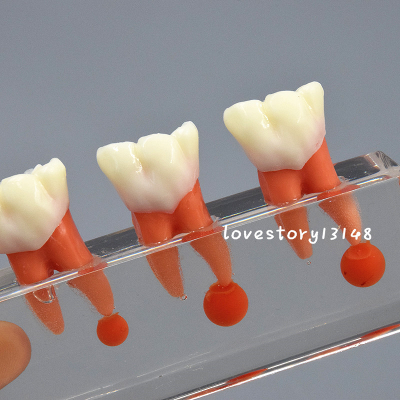 1 Set Dental Teeth Model #4018 01 - 4-Stage Endodontic Treatment Study Model