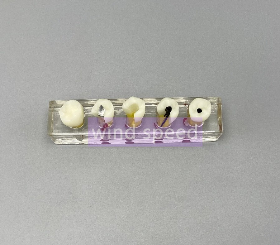 Dental Study Model Pulp Disease root canal curing Clinical Demonstration Analysi