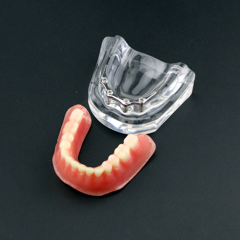 Dental Teeth Model Inferior Overdenture Precision 4 Implants Demo Silver Bar