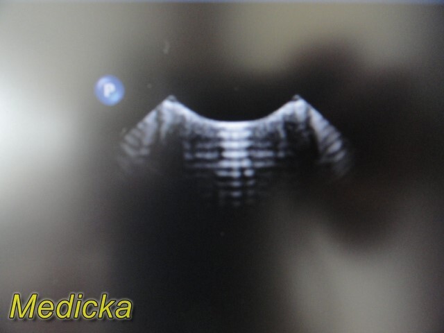 Philips X6-1 Phased Array Ultrasound Probe (Ref 453561247501) *TESTED* ~ 33768