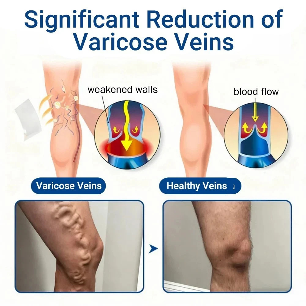 GFOUK VeinTarget Microdarts Patch Professional Leg Varicose Veins Patch 4Pc-7Day