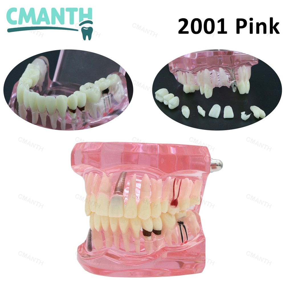 Dental Model Bridge Restoration Pathology Study Demo Teaching Model M2001