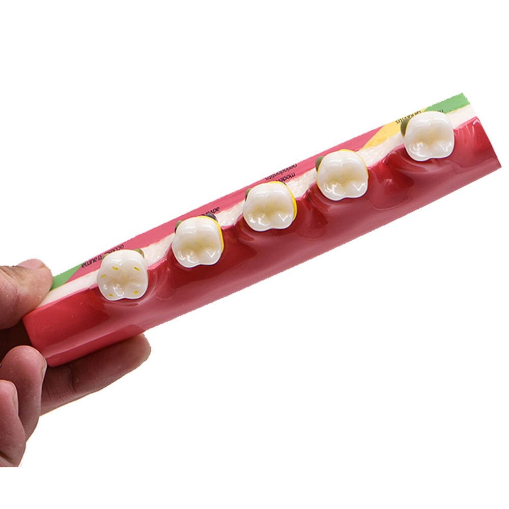 Dental Periodontal Disease Model Assort Teeth Study Teaching Tooth Shape Symptom