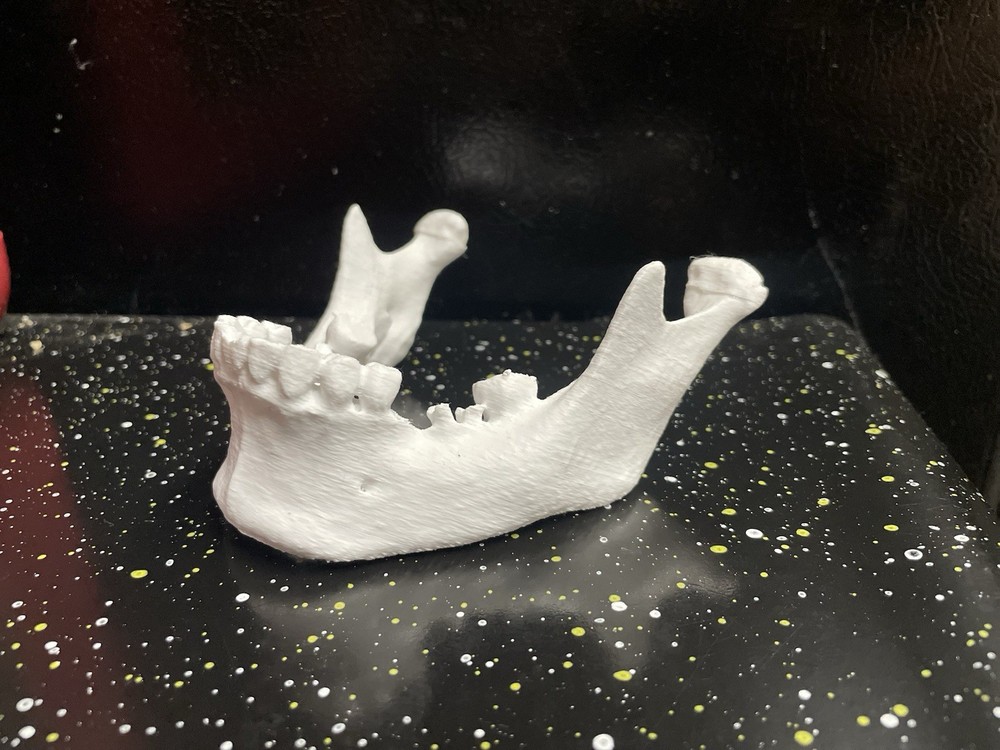 3D PRINTED HUMAN 3d JAW BONE