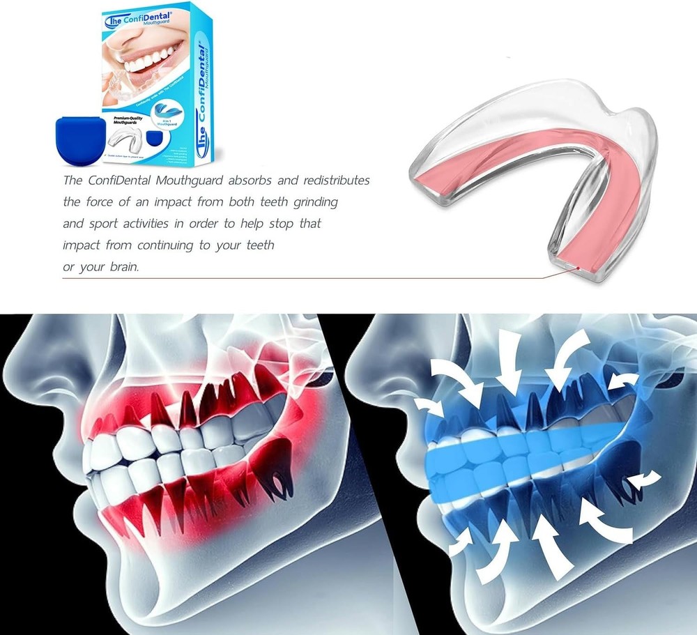 Durable Moldable Mouth Guards: 4-Piece Set for Teeth Grinding & Athletic Use