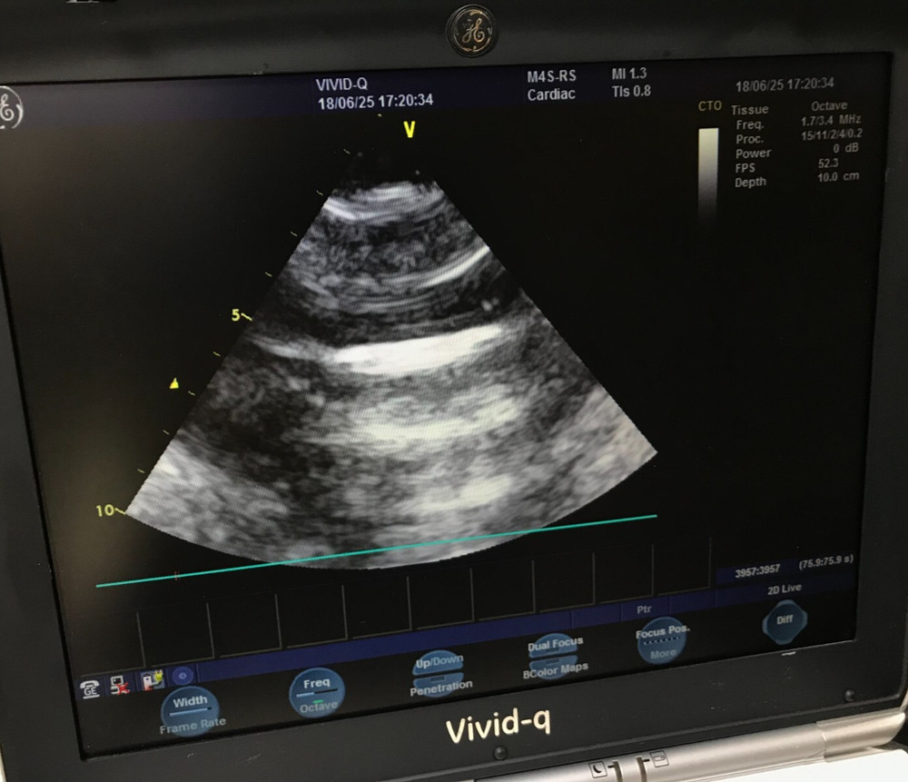 GE M4S-RS Phased Array Ultrasound Probe Transducer
