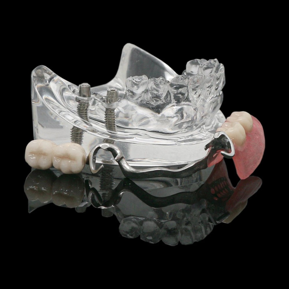 Dental Typodont Model M6022-C w/ Partial Denture 2 Demo& Implants Restoration