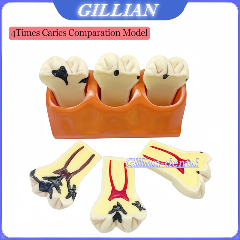 4 Times Caries Comparation Models Dental Detachable Abutment Teach Study Model