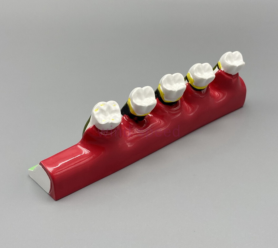 Dental Teeth Dentoform Typodont Caries Periodontal Disease Study Teaching Model