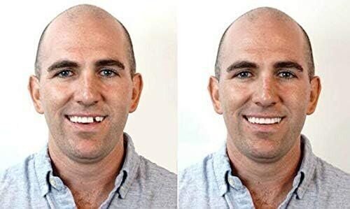 Instant Smile Emergency Temporary Tooth Replacement Kit