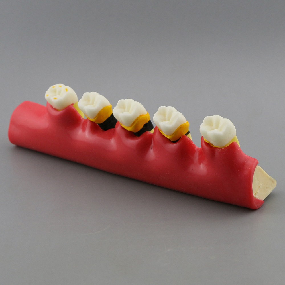 Dental Study Teaching Model Periodontal Disease Assort Teeth Dentoform Typodont