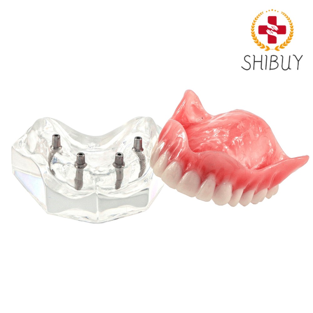1pc Implant Overdenture Teeth Model Demo Restoration Upper 4 Implants