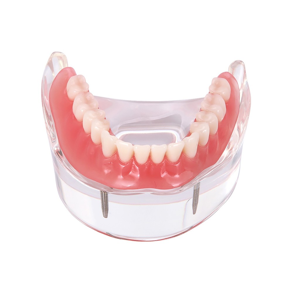 Dental Implant With 2 Implants Teeth Demo Model Overdenture Restoration Model