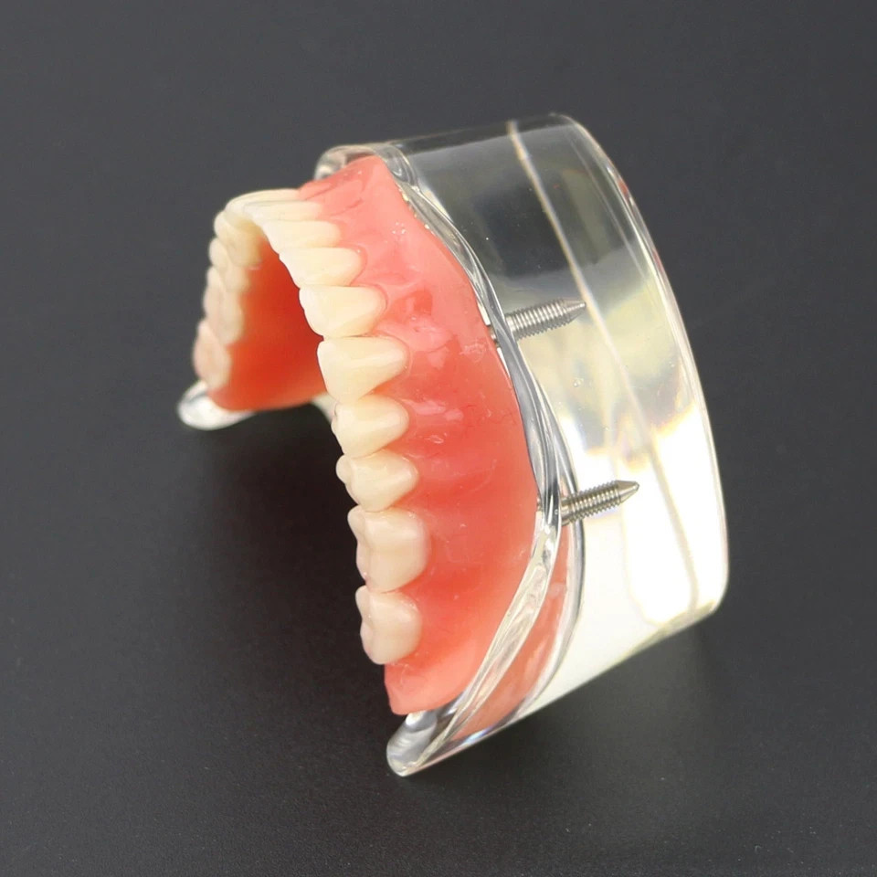 Dental 2/4 Implants Upper Lower Teeth Model Lower Demo Overdenture Restoration