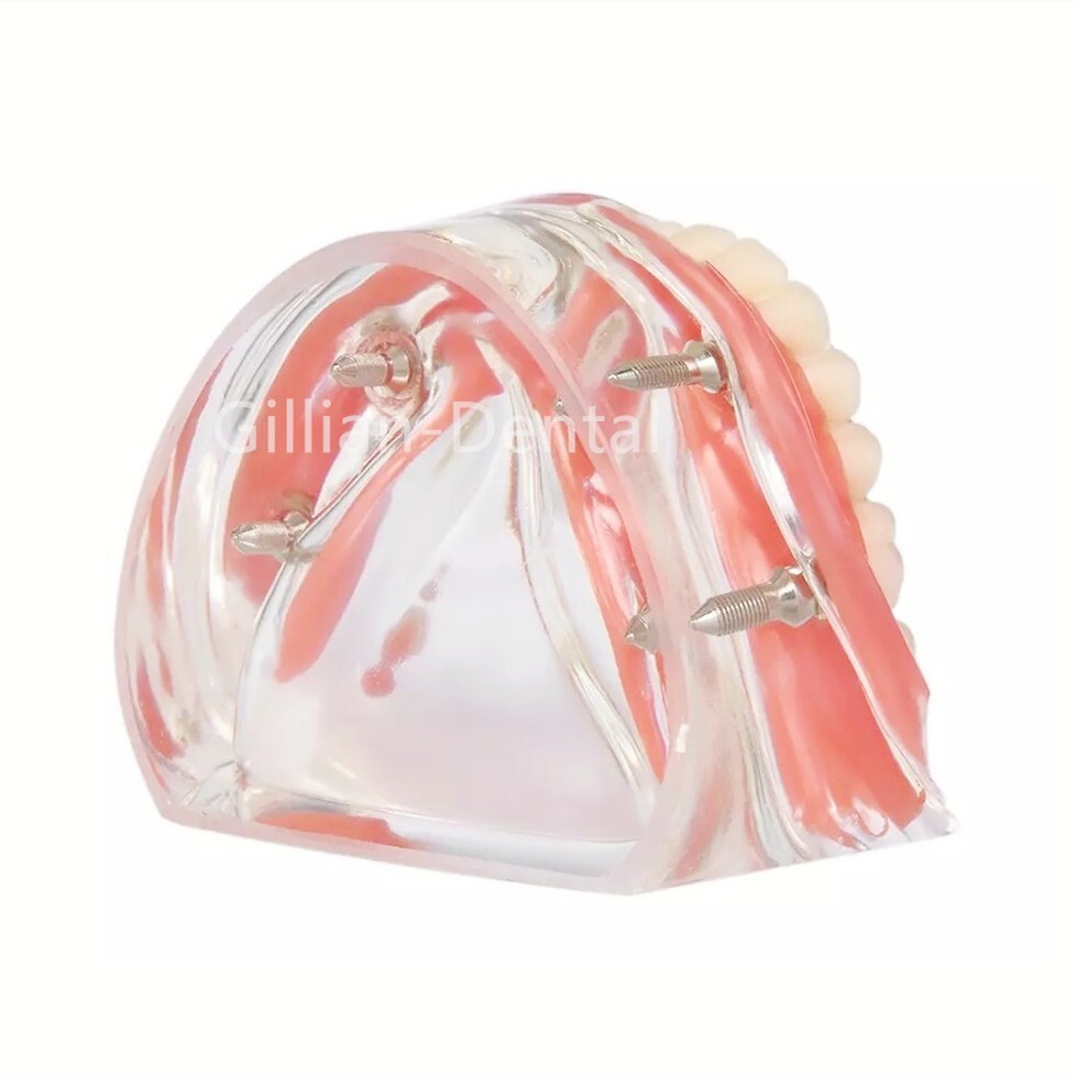 Dental Study Teach Teeth Model With Overdenture Inferior Demo 4 Implants