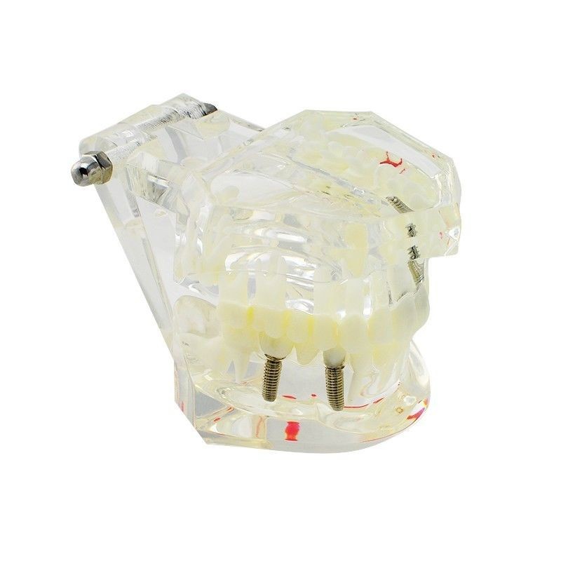 4 Pcs 4 Sizes Dental Restoration Model Implant Pathological Disease Teeth Study