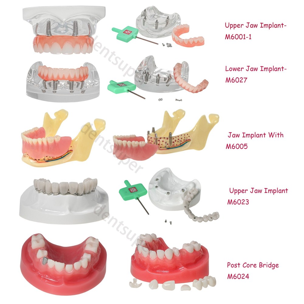 Dental Implant Overdenture Restoration Style Upper Lower Teeth Model Typodont