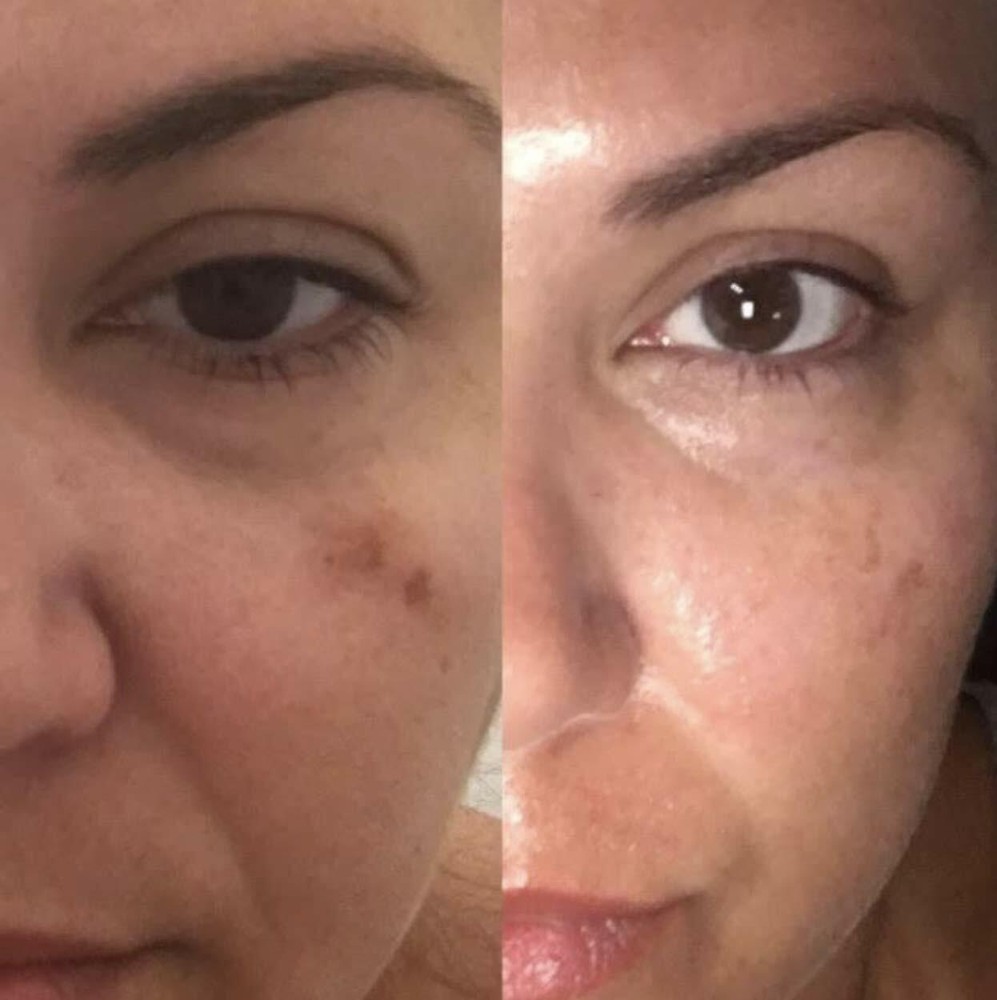 Dark Spot Remover for Face, Dark Spot Corrector, Hyperpigmentation Treatment 1oz