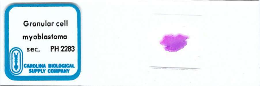 Human Granular Cell Myoblastoma Pathology Microscope Slide