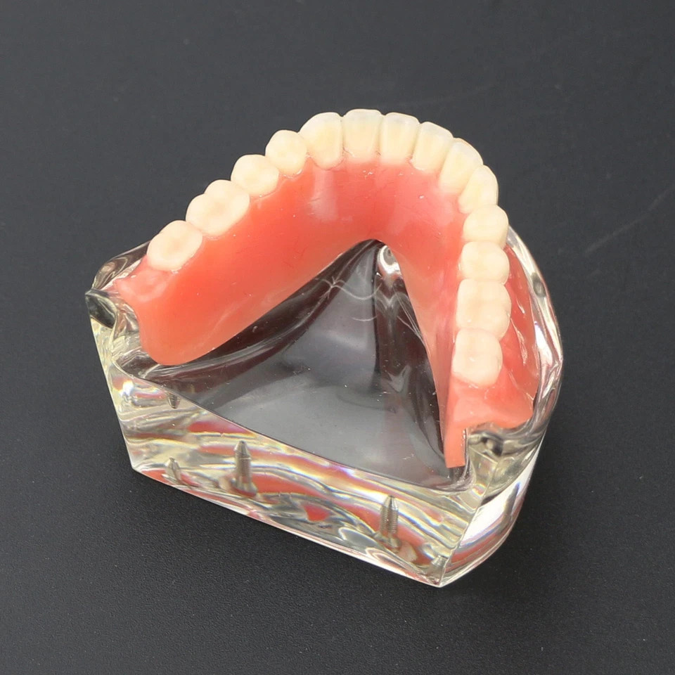 Dental 2/4 Implants Upper Lower Teeth Model Lower Demo Overdenture Restoration