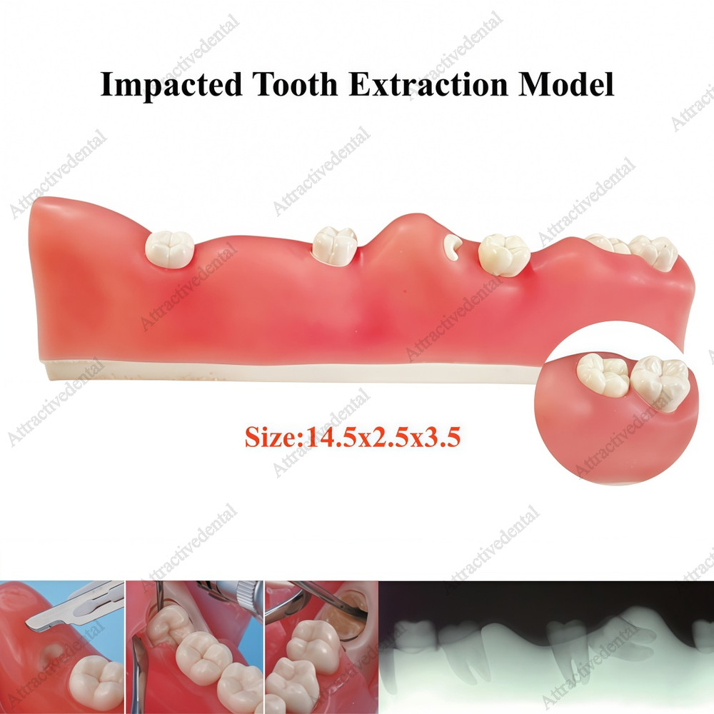 Dental Impacted Tooth Model Wisdom Unerupted Tooth Extraction Practice Training