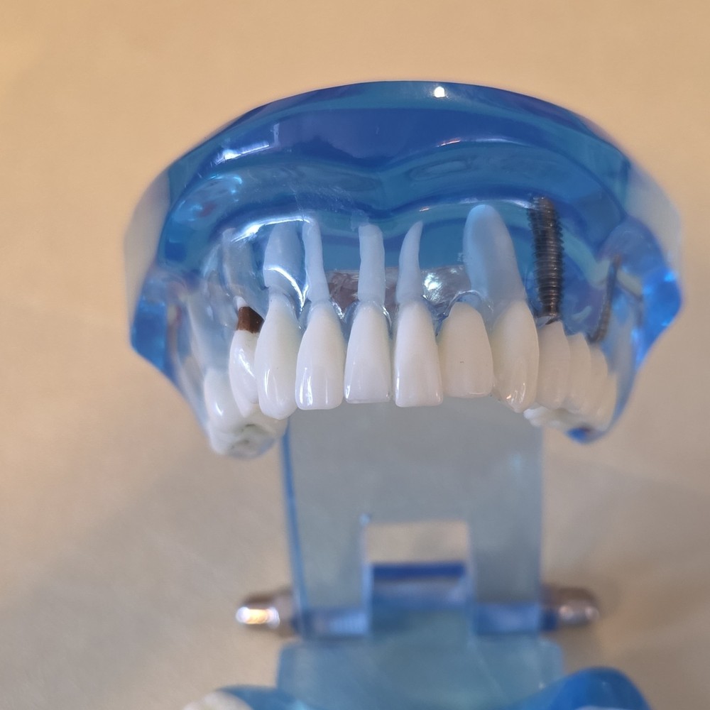 Typodont Dental Model with Removable Teeth, Implants, Blue Transparent Base