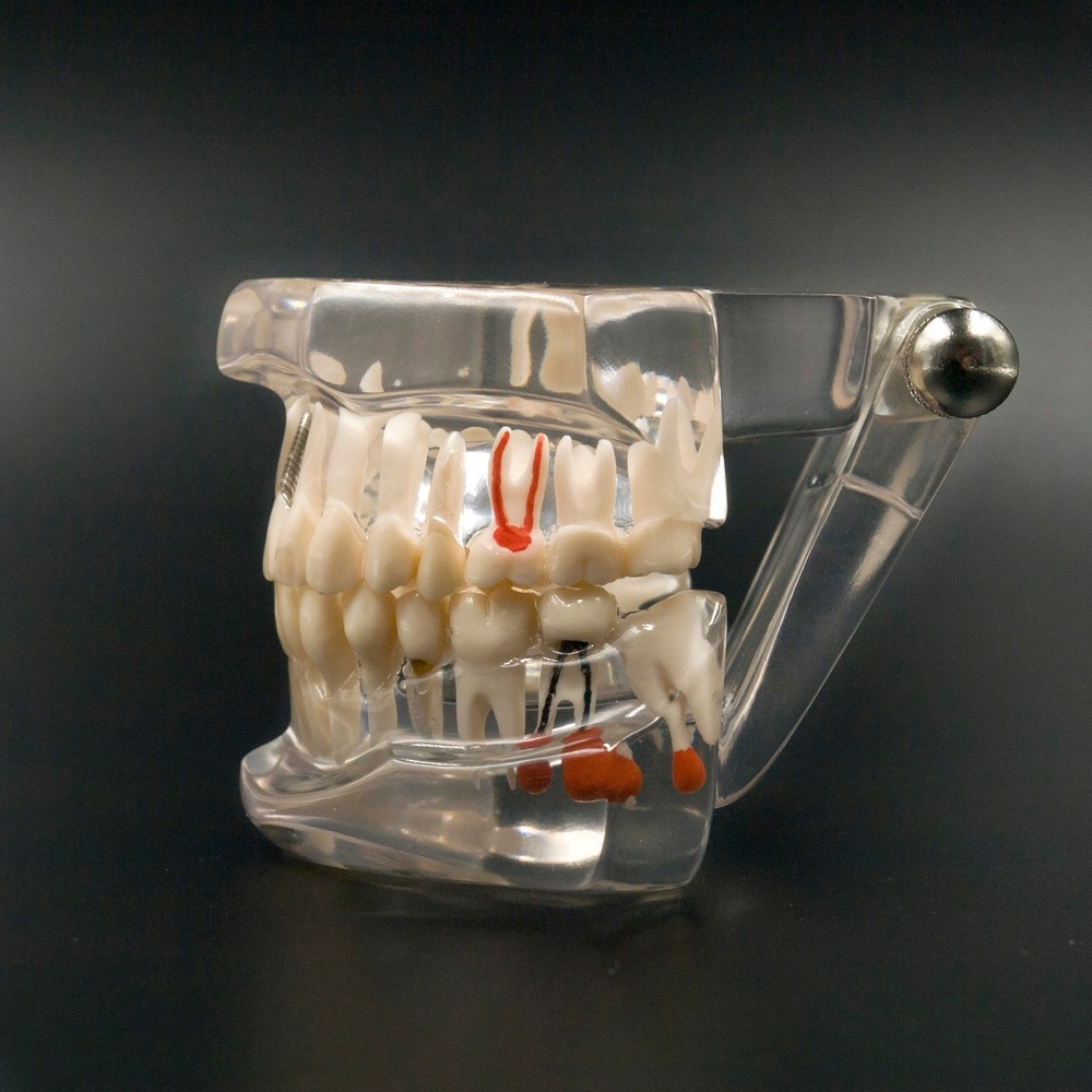 Dental Implant and Restoration Model Transparent Pathological Teeth Study Model
