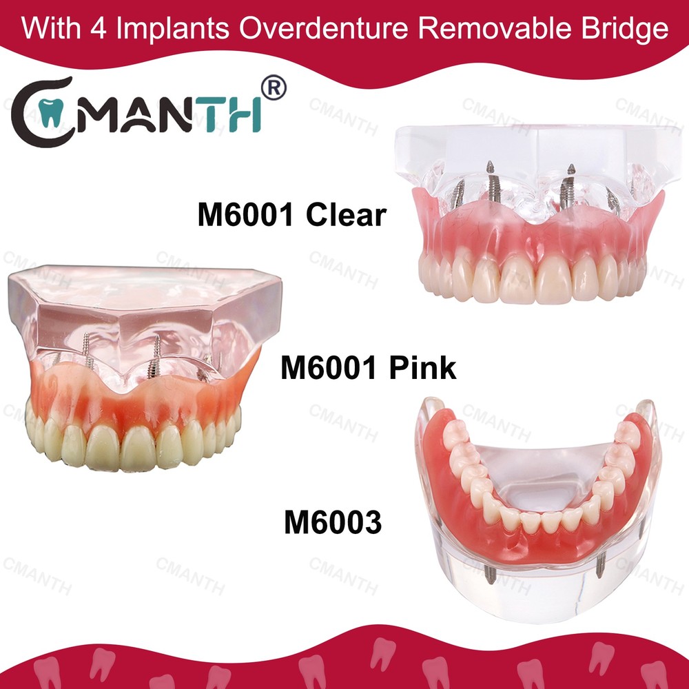Dental Teeth Model Upper Lower Tooth 4 Implants Restoration Overdenture Model