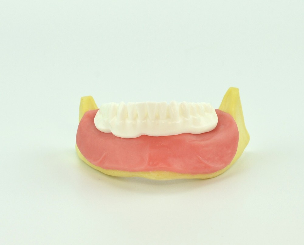 Dental Mandibular Implant Plus Denture Training Model Implant Placement