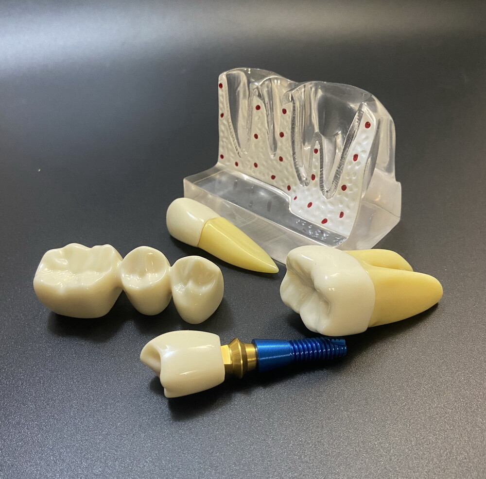 Dental Teaching Model Removable Communication Models Crown Bridge 4 Times Impant