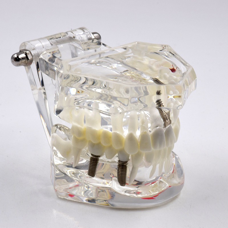 Dental Removable Restoration &Implant Pathological Disease Teeth Study Model