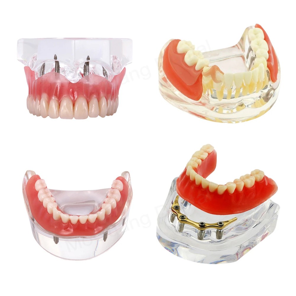 Dental Model with Removable Restorable Teeth Education Model Overdenture Teeth