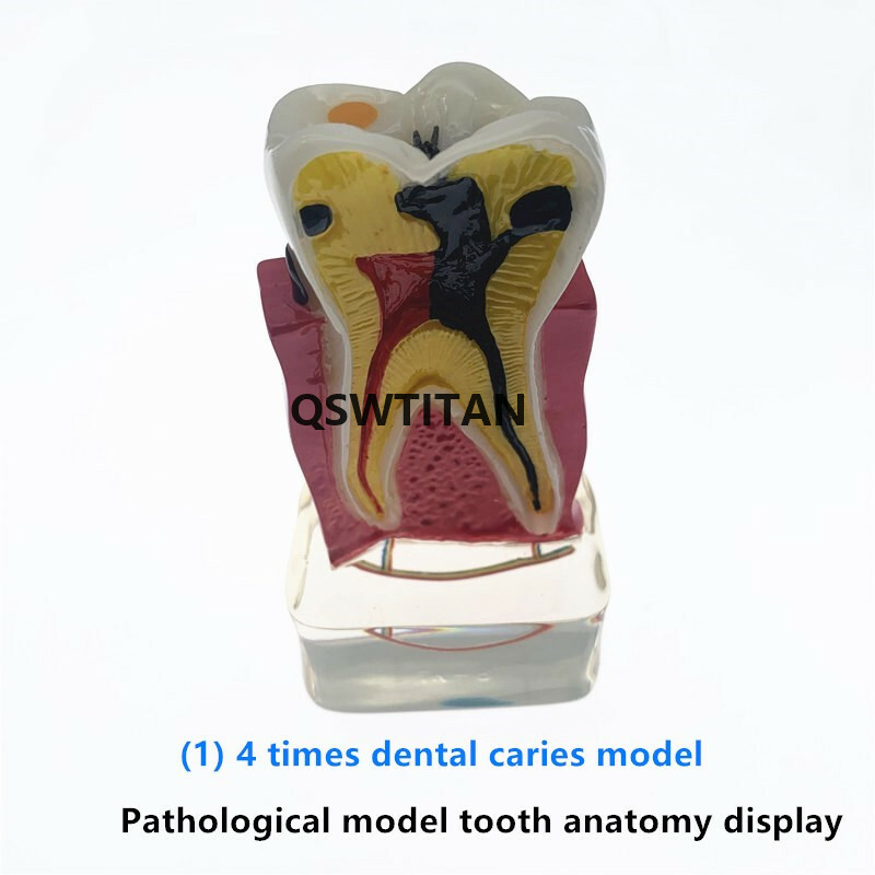 Teeth Model 4 times tooth pathology Comprehensive Periodontal teaching models
