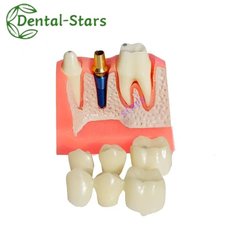 1x Dental Implant Analysis Crown Bridge Demonstration Teeth Teaching Model Study