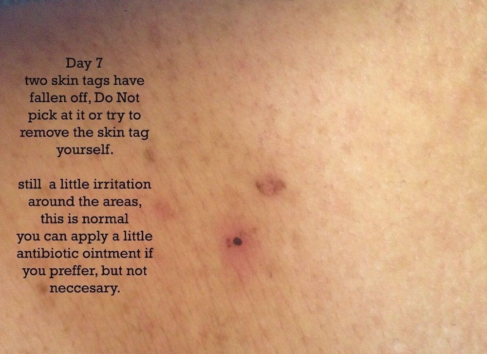 10ml Mole Wart and Skin Tag Remover