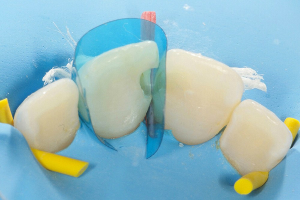 Dental Contoured Anterior Matrix Bands Polyester Anterior Strips Matrices System