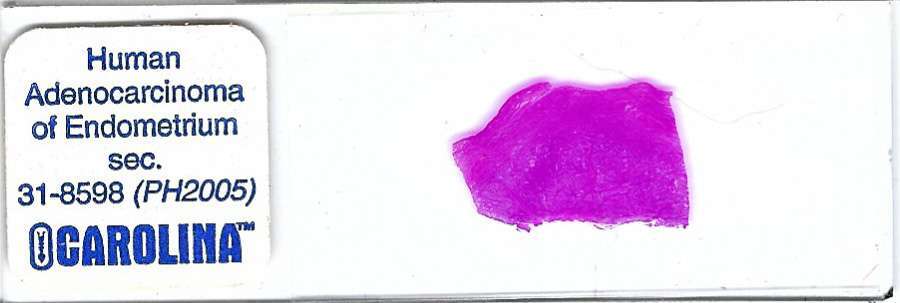 Human Adenocarcinoma of Endometrium Pathology Microscope Slide