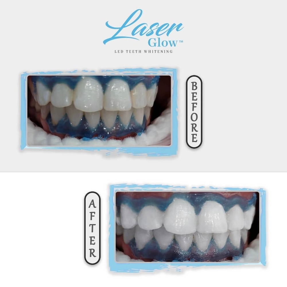 Gingival Barrier Gum Protector Professional Gum Protector for Teeth Whitening