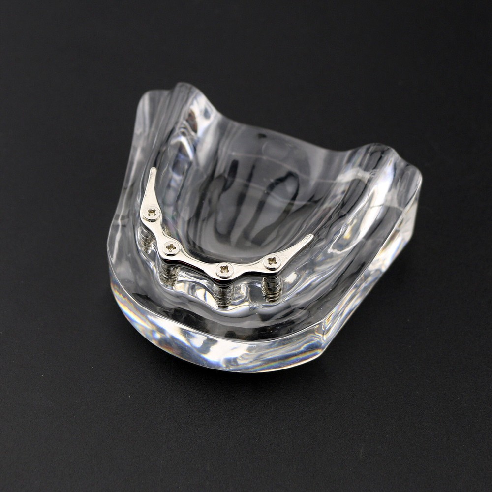 Dental Overdenture Study Demo Model Inferior M6008 Lower 4implants Silver Teeth