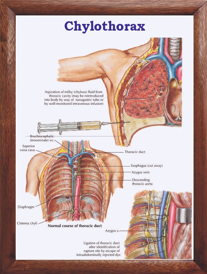 Chylothorax Chart 12x18 inches