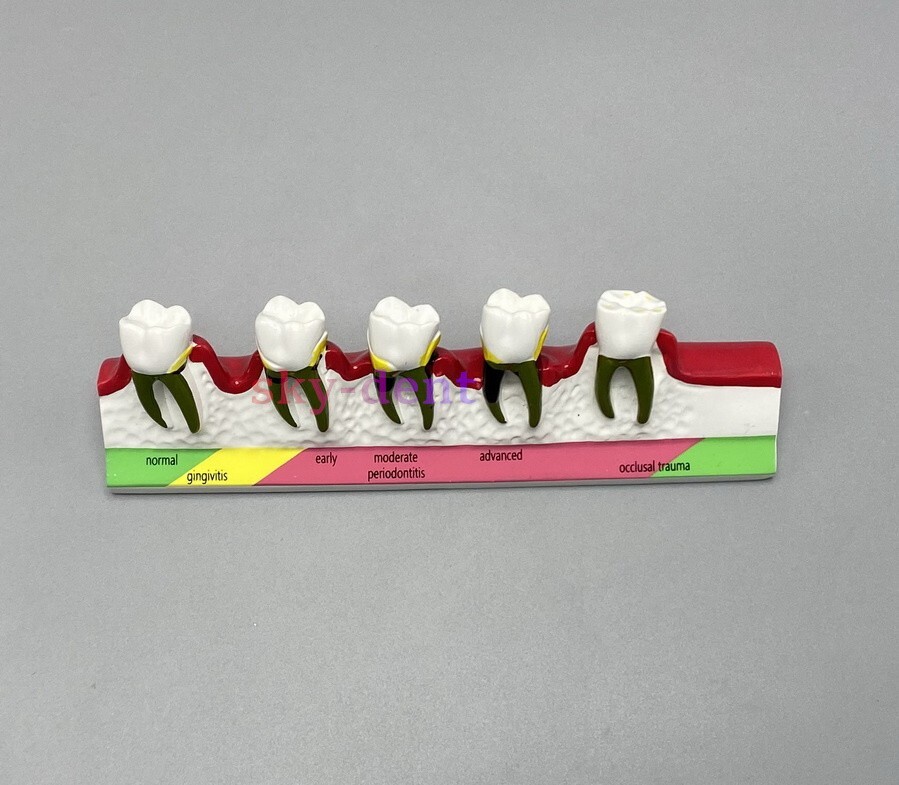 Dental Typodont Teeth Model Ortho Implant Pathological Perio Practice Demo Model