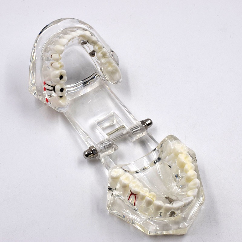Dental Removable Restoration &Implant Pathological Disease Teeth Study Model