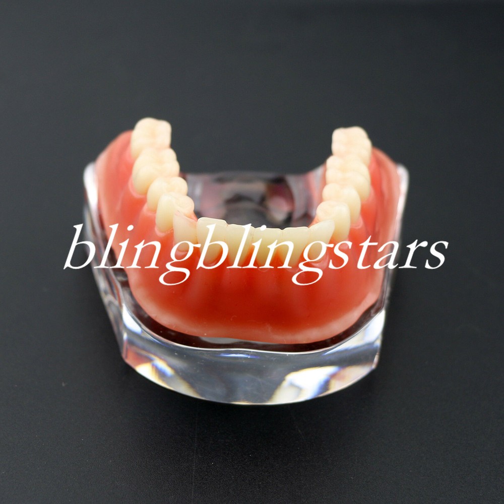 Dental Overdenture Restoration Typodont Implant Teeth Model Silver Bar