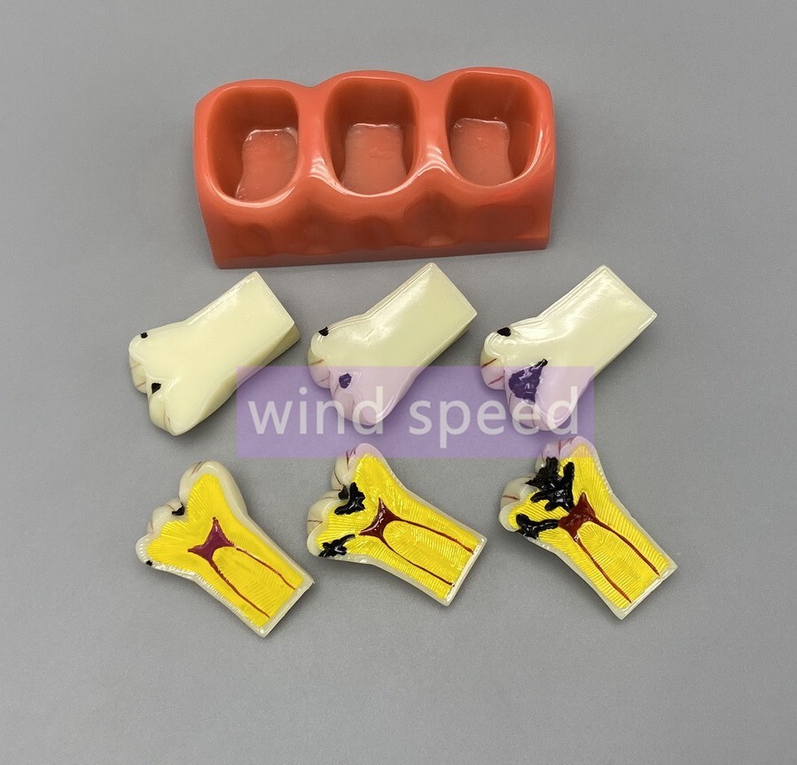 Dental Teaching Model 4 Times Caries Disassembling Comparations Implant Model