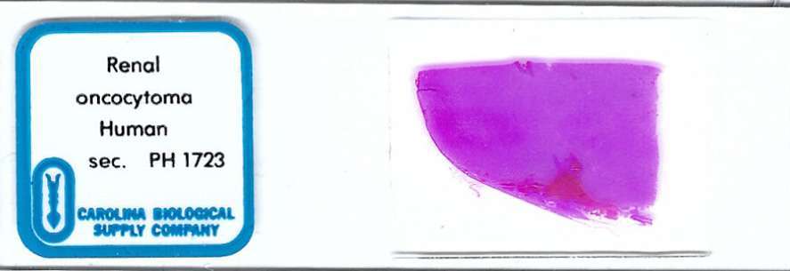 Human Renal Oncocytoma Pathology Microscope Slide