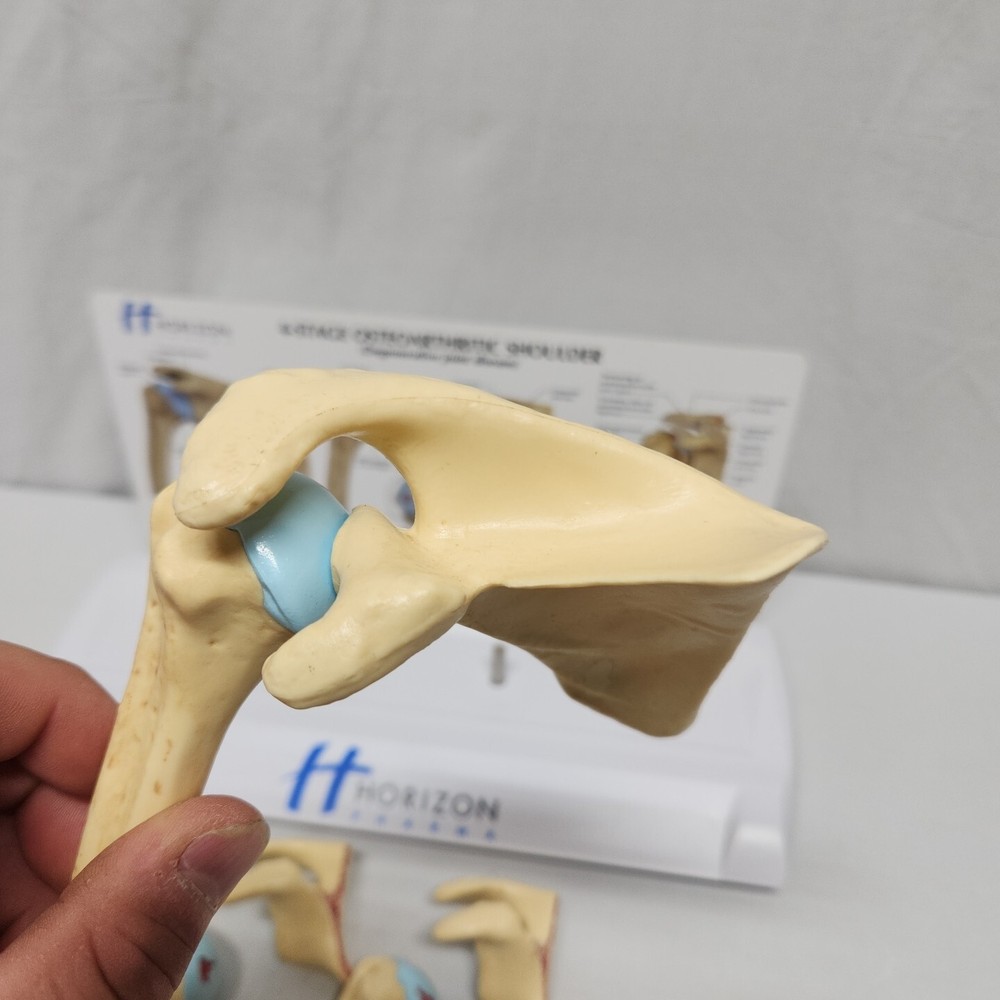 Degenerative Joint Disease 4 Stage Osteoarthritis Osteoarthritic Shoulder Model