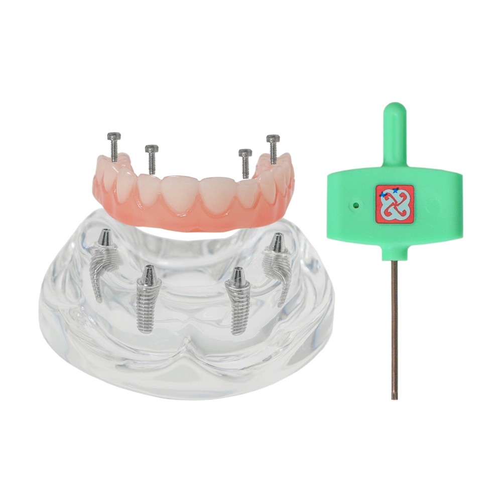 Dental Implant Disease Teeth Model Overdenture Implants Upper/Lower Demo