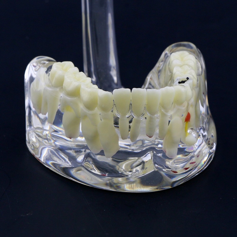 Dental Children Pediatric Pathology Demonstration Study Tooth Teeth Model 4002